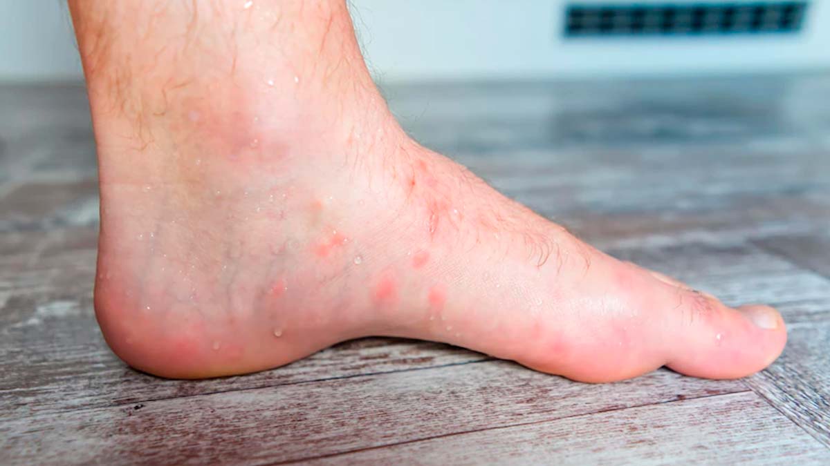 Monsoon Maladies Why Are Foot Infections Common In Rainy Season
